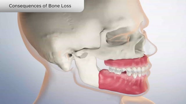 Consequences of Bone Loss - Dental Patient Education Video