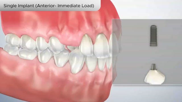 Single Implant (Anterior- Immediate Load) - Dental Patient Education Video