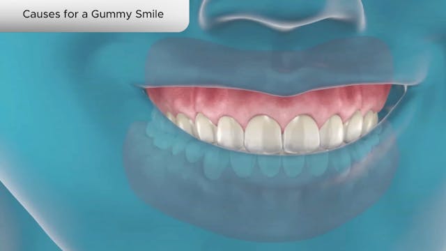 Causes for a Gummy Smile - Dental Patient Education Video