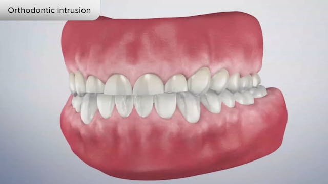 Orthodontic Intrusion - Dental Patient Education Video