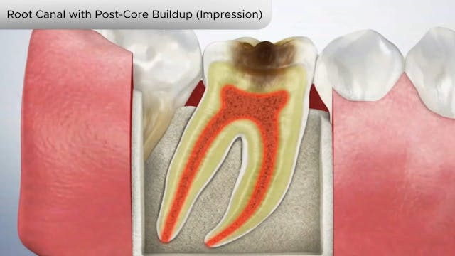 Root Canal with Post-Core Buildup (Impression) - Dental Patient Education Video