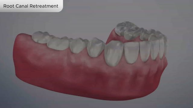 Root Canal Retreatment - Dental Patient Education Video