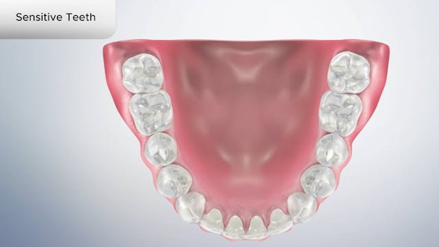 Sensitive Teeth - Dental Patient Education Video