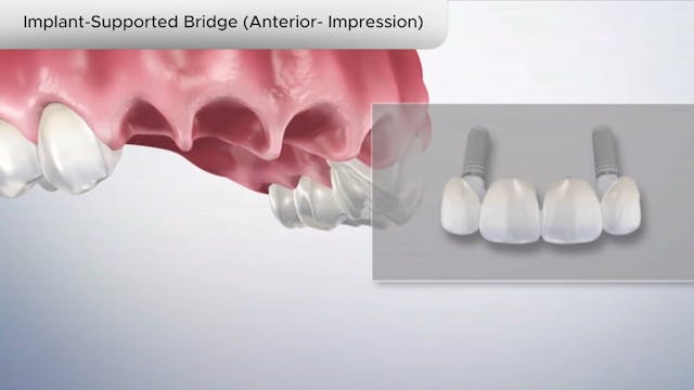 Implant-Supported Bridge (Anterior- Impression - Dental Patient Education Video