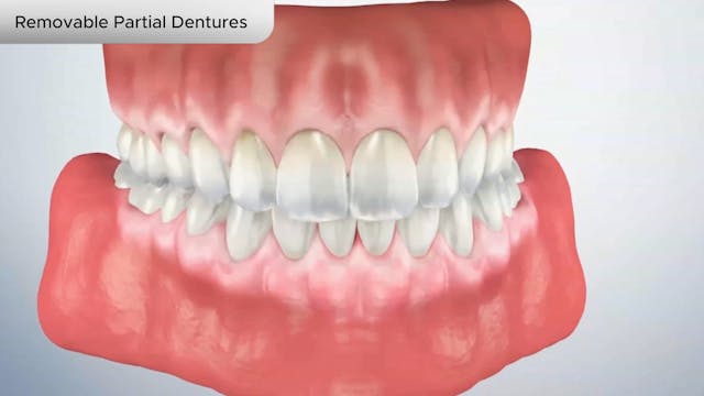 Removable Partial Dentures - Dental Patient Education Video