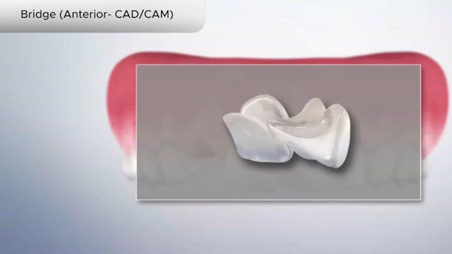 Bridge (Anterior- CADCAM) - Dental Patient Education Video