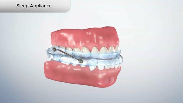 Sleep Appliance - Dental Patient Education Video