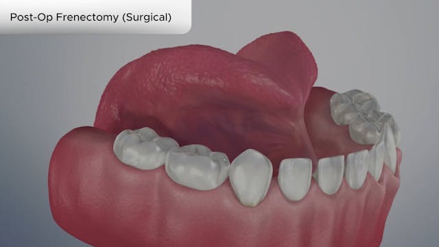 Post-Op Frenectomy (Surgical) - Dental Patient Education Video