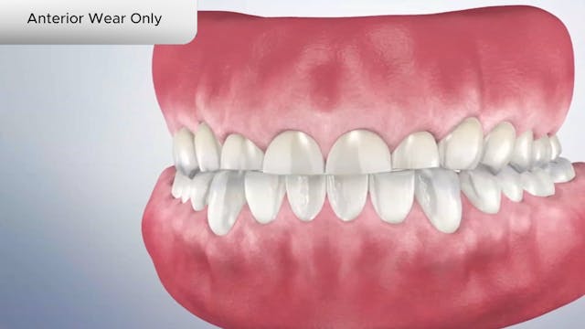 Anterior Wear Only - Dental Patient Education Video