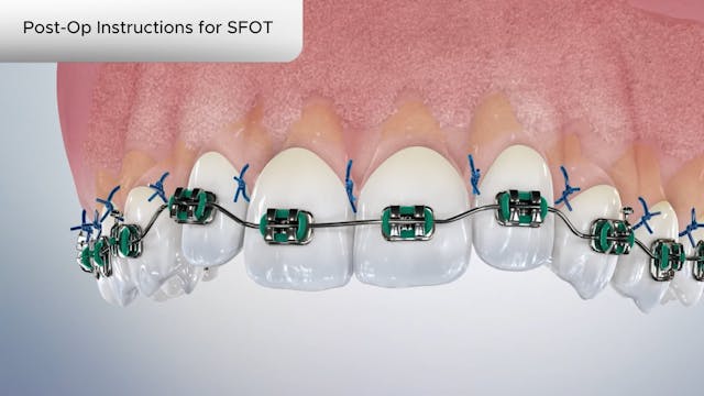 Post-Op Instructions for SFOT - Dental Patient Education Video