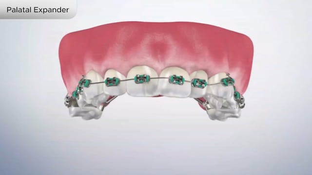 Palatal Expander