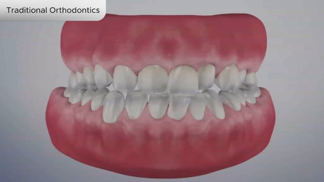 Traditional Orthodontics - Dental Patient Education Video