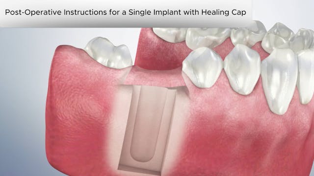 Post-Operative Single Implant with Healing Cap-Dental Patient Education Video