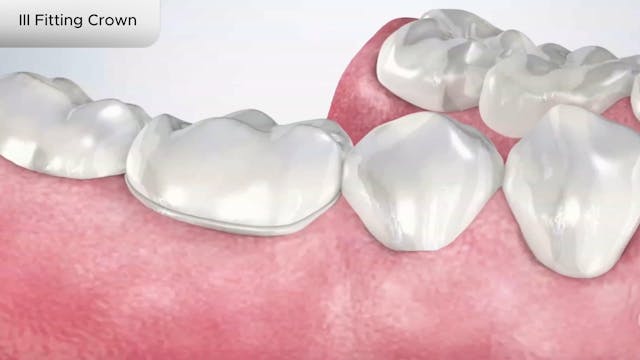 Ill Fitting Crown - Dental Patient Education Video