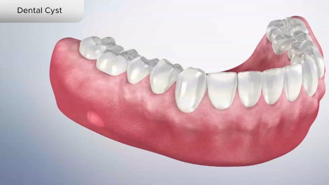 Dental Cyst - Dental Patient Education Video