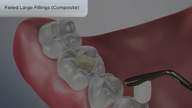 Failed Large Fillings (Composite) - Dental Patient Education Video