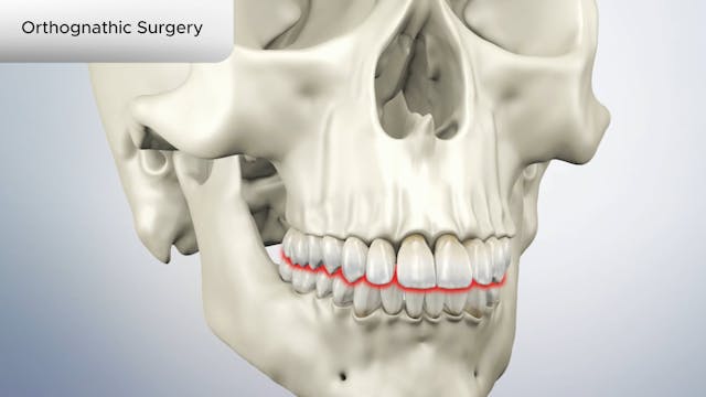 Orthognathic Surgery - Dental Patient Education Video