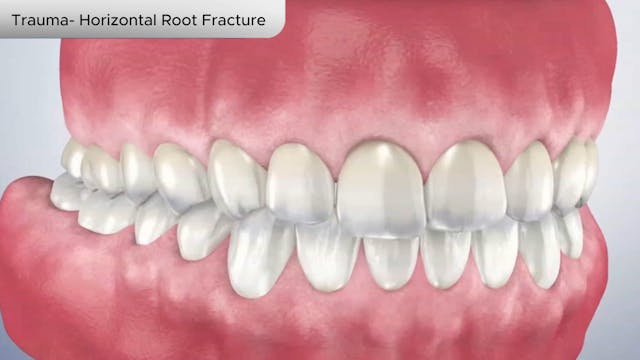 Trauma- Horizontal Root Fracture - Dental Patient Education Video