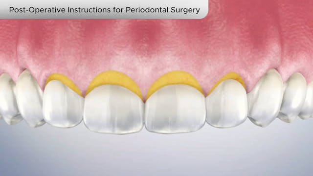 Post-Operative Instructions Periodontal Surgery - Dental Patient Education Video