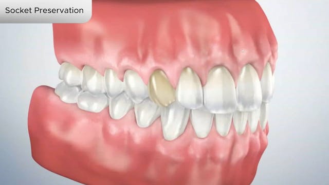 Socket Preservation - Dental Patient Education Video