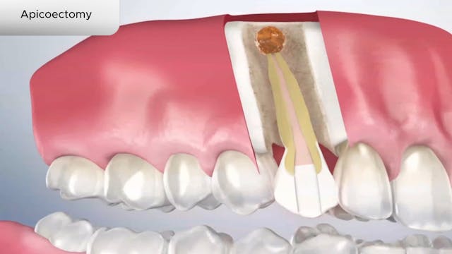 Apicoectomy - Dental Patient Education Video