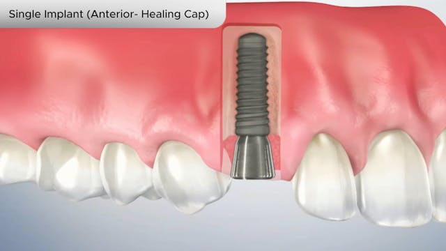 Single Implant (Anterior- Healing Cap) - Dental Patient Education Video