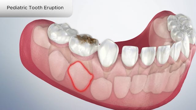 Pediatric Tooth Eruption - Dental Patient Education Video