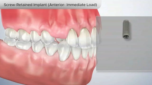 Screw-Retained Implant (Anterior-Immediate Load) -Dental Patient Education Video