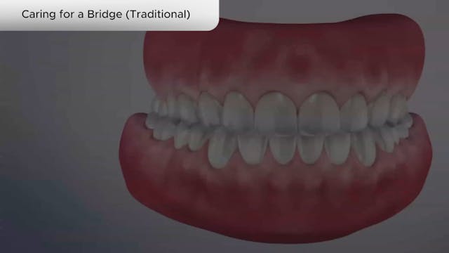 Caring for a Bridge (Traditional) - Dental Patient Education Video