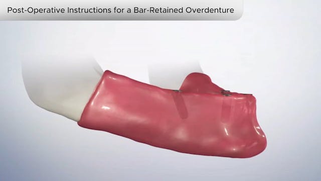 PostOperative Instruction BarRetained Overdenture-Dental Patient Education Video