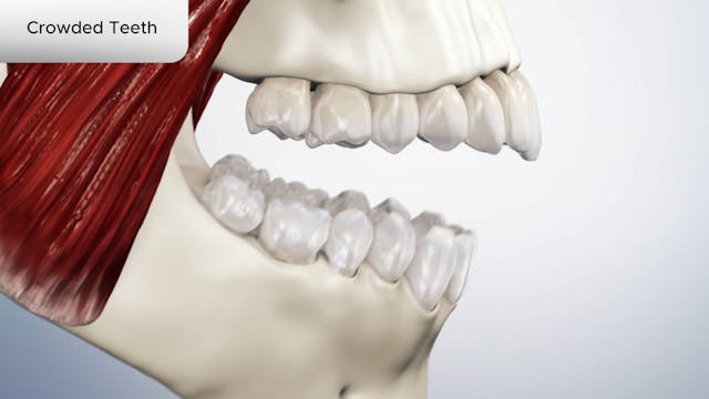 Crowded Teeth - Dental Patient Education Video