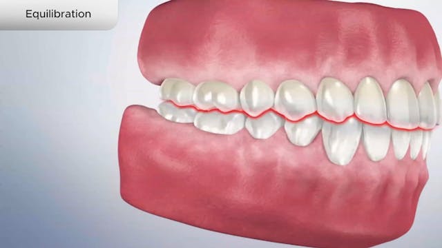 Equilibration - Dental Patient Education Video