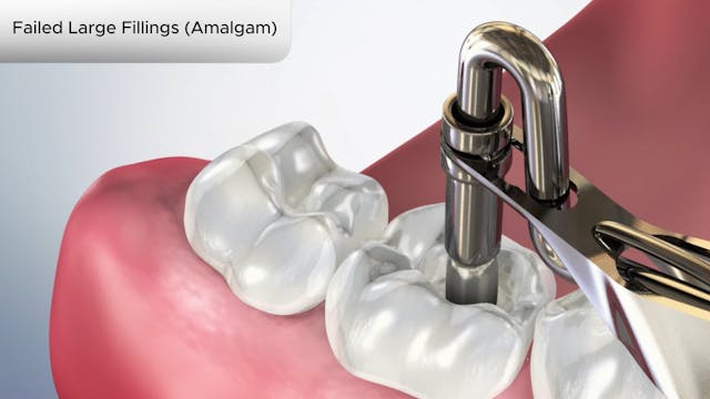 Failed Large Fillings (Amalgam) - Dental Patient Education Video