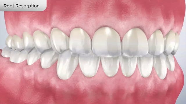 Root Resorption - Dental Patient Education Video