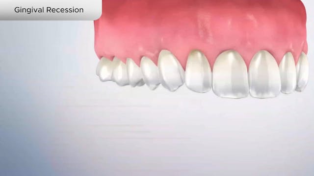 Gingival Recession - Dental Patient Education Video