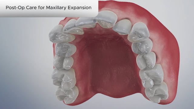 Post-Op Care for Maxillary Expansion - Dental Patient Education Video