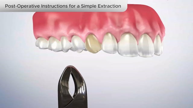 Post-Operative Instructions Simple Extraction - Dental Patient Education Video