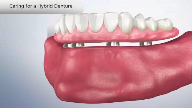 Caring for a Hybrid Denture - Dental Patient Education Video