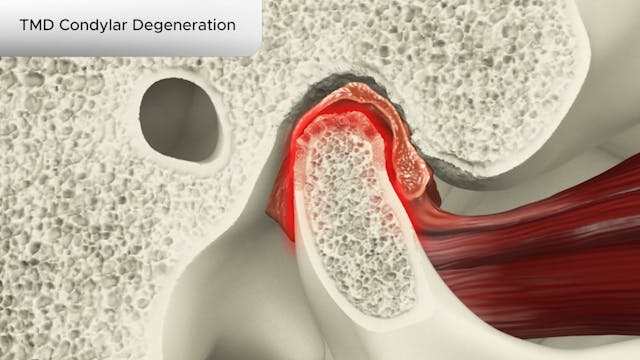 TMD Condylar Degeneration - Dental Patient Education Video