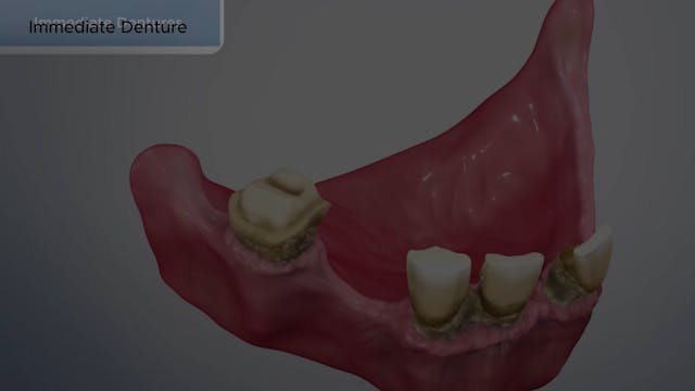 Immediate Dentures - Dental Patient Education Video