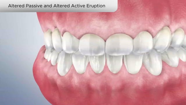 Altered Passive and Altered Active Eruption - Dental Patient Education Video