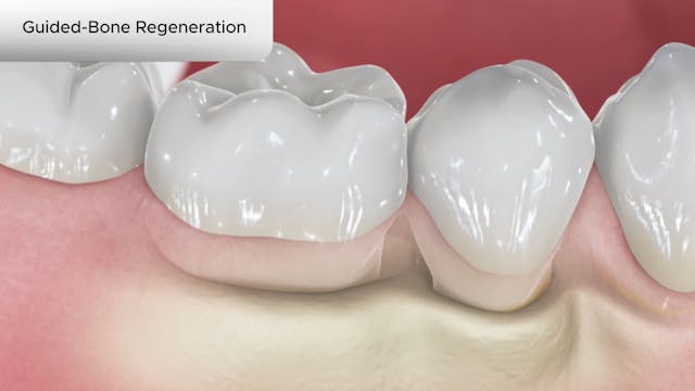 Guided-Bone Regeneration - Dental Patient Education Video