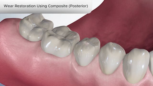 Wear Restoration Using Composite (Posterior) - Dental Patient Education Video