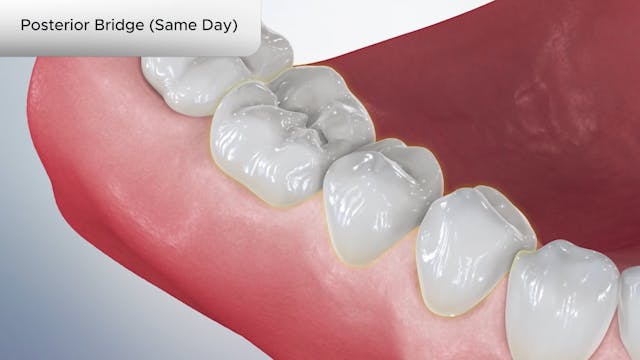 Posterior Bridge (Same Day) - Dental Patient Education Video