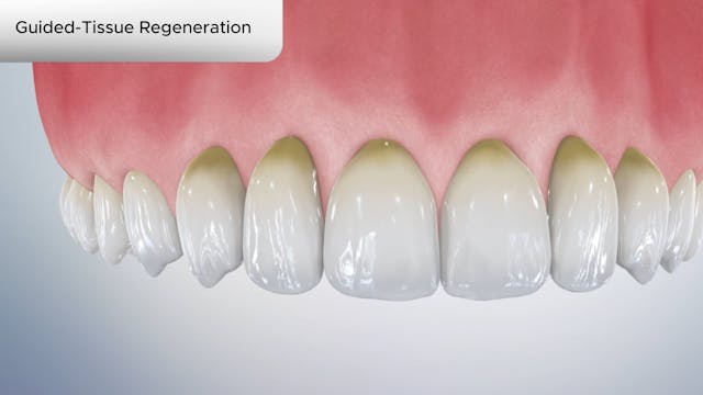 Guided-Tissue Regeneration - Dental Patient Education Video