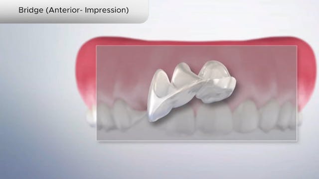 Bridge (Anterior- Impression) - Dental Patient Education Video