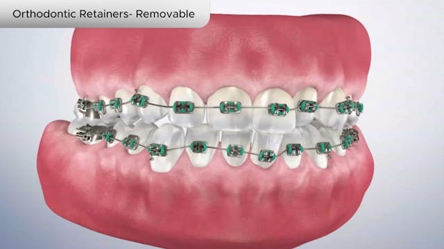 Orthodontic Retainers- Removable - Dental Patient Education Video