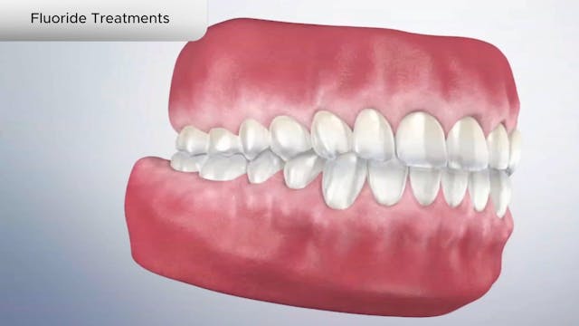 Fluoride Treatments - Dental Patient Education Video