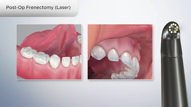 Post-Op Frenectomy (Laser) - Dental Patient Education Video