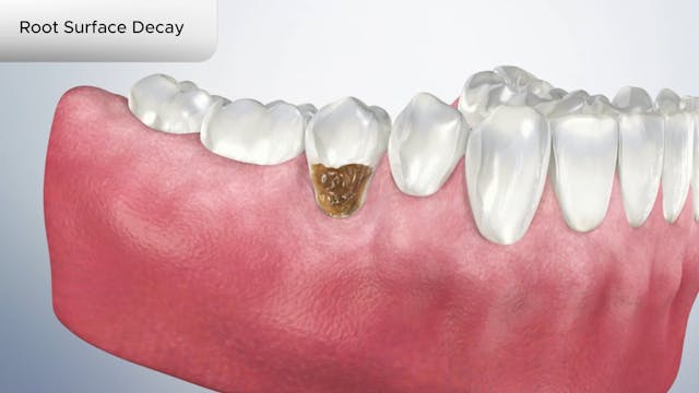 Root Surface Decay - Dental Patient Education Video